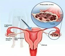 Ovarian removal should be avoided in premenopausal women: Study